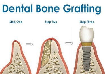 dental bone grafting irvine orange county