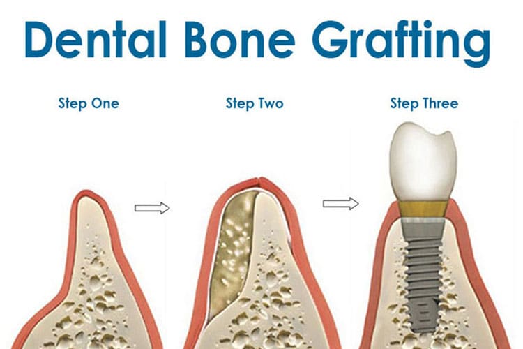 dental bone grafting irvine orange county