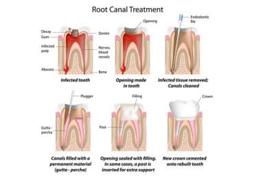root canal treatment irvine orange county