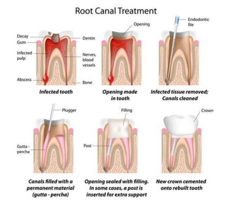 root canal treatment irvine orange county