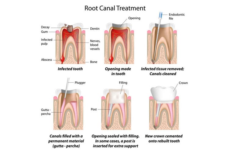 root canal treatment irvine orange county