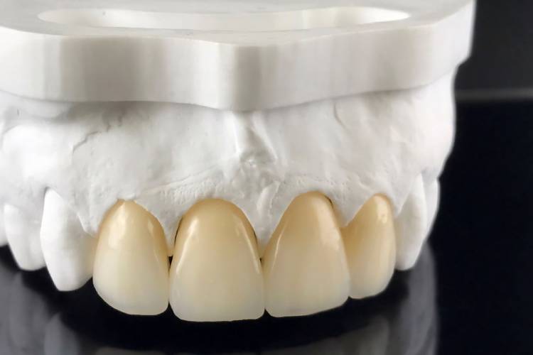 dental crown orange county ca