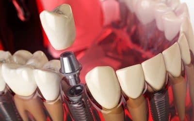 dental implants orange county