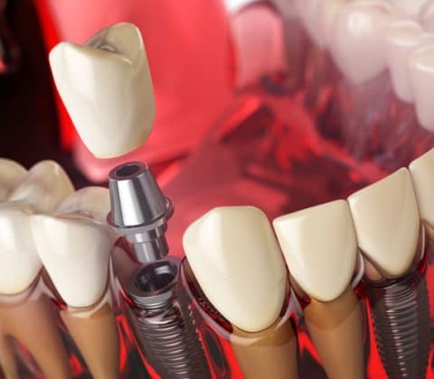 dental implants orange county