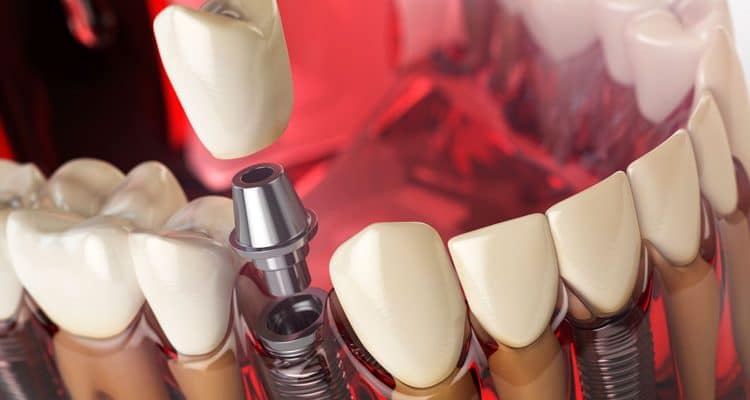 dental implants orange county