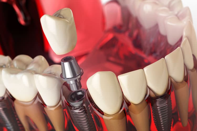 dental implants orange county