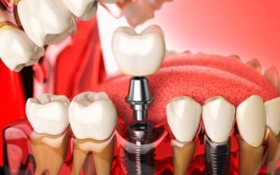 dental implants orange county