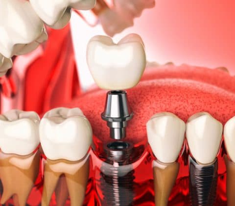 dental implants orange county