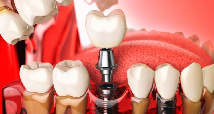 dental implants orange county