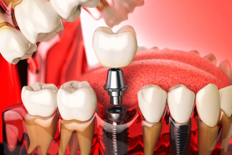 dental implants orange county